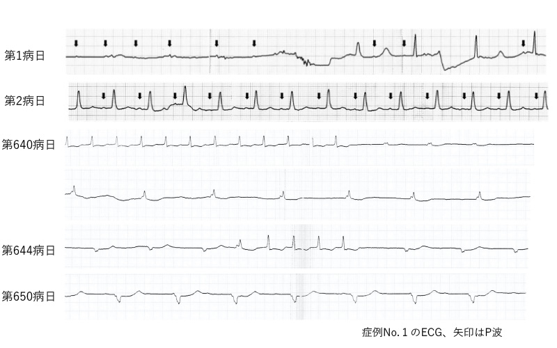 不整脈を認めた症例の心電図の経過