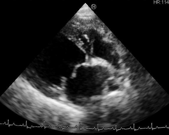 僧帽弁閉鎖不全症の症例のエコー検査