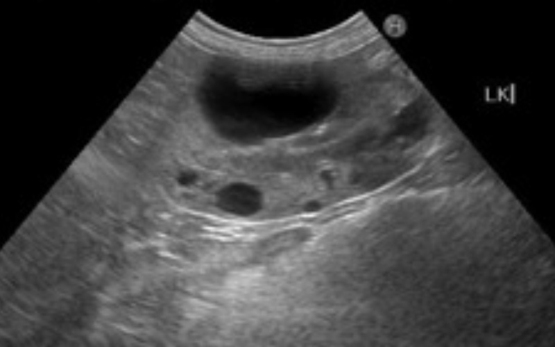 多発性嚢胞腎　腎臓内に多数の嚢胞の袋が見られます。