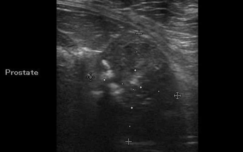 前立腺癌のエコー画像です