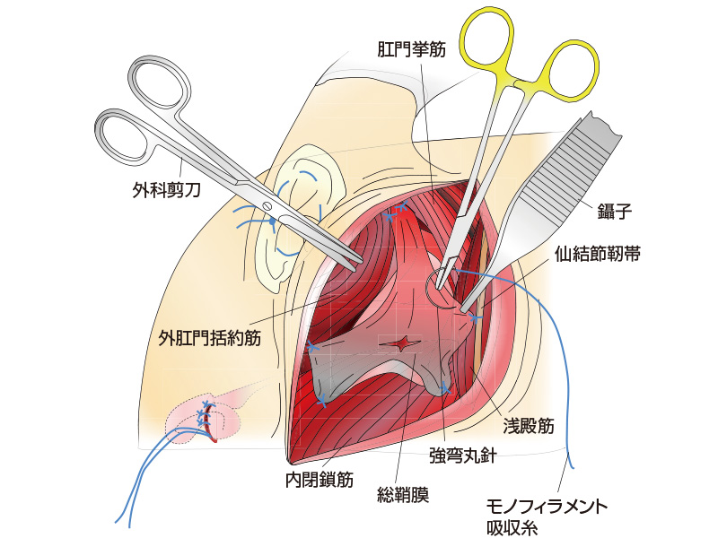 総鞘膜を使った整復術