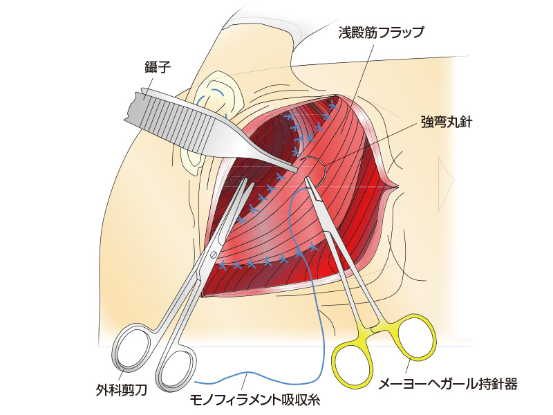 筒状包皮粘膜縫合法の術後写真