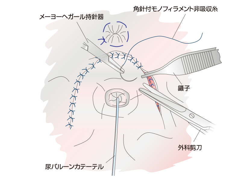 筒状包皮粘膜縫合法の術後写真