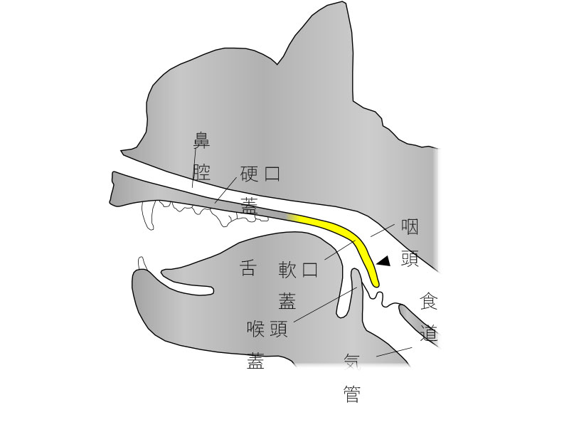 軟口蓋過長症の軟口蓋遊離縁の位置