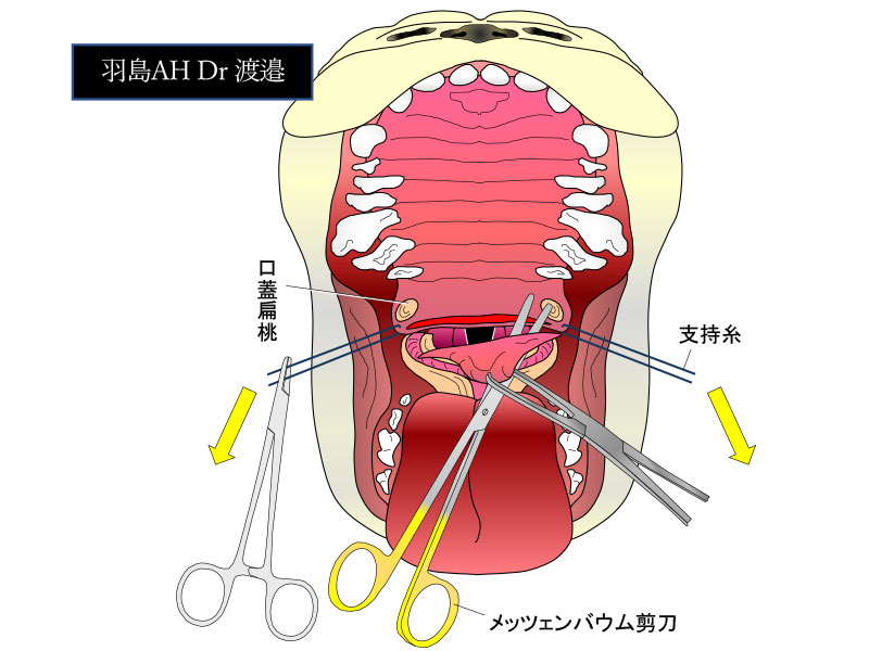 過長軟口蓋の切除