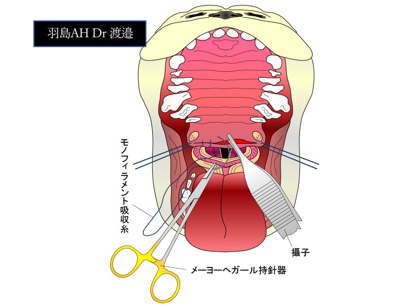 軟口蓋断端の縫合