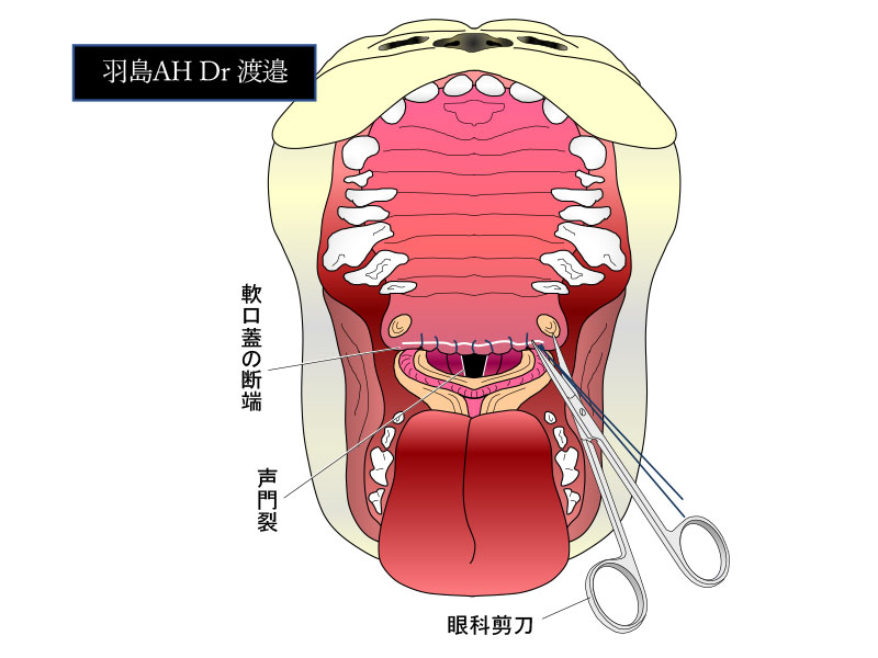 軟口蓋の長さの確認