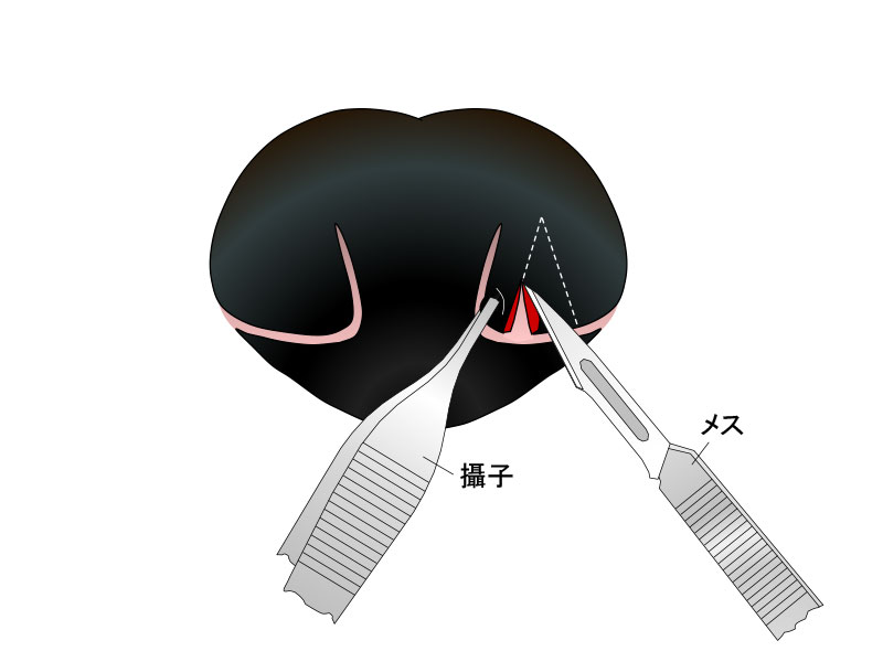 尾翼の内側切除