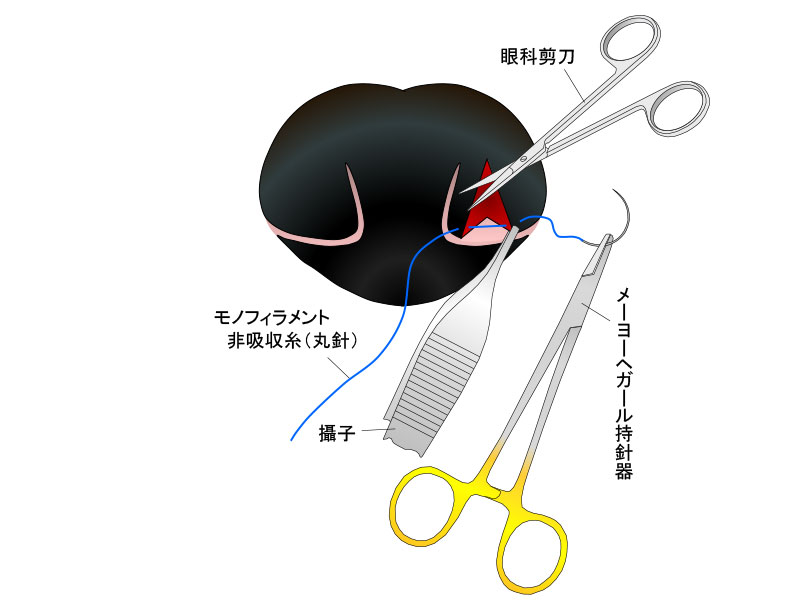 切開縁の縫合