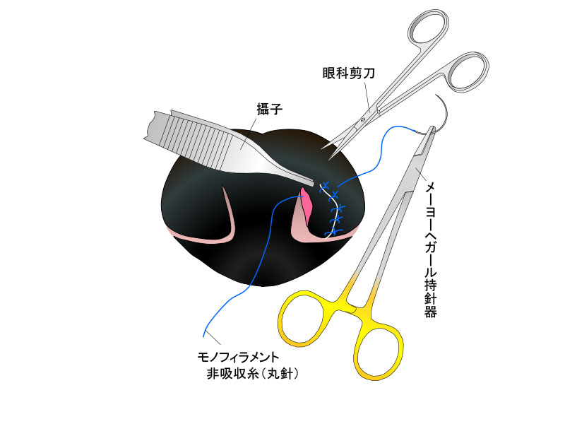 鼻軟骨の縫合